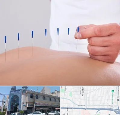 دکتر طب سوزنی در بلوار ابوذر