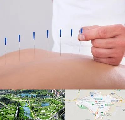 دکتر طب سوزنی در بجنورد