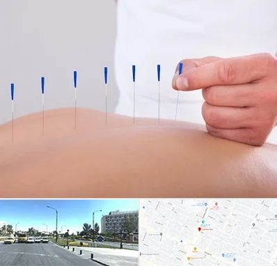 دکتر طب سوزنی در بلوار کلاهدوز مشهد