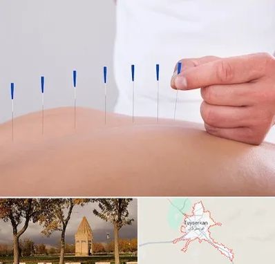 دکتر طب سوزنی در تویسرکان