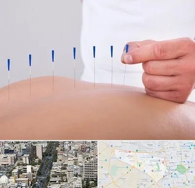 دکتر طب سوزنی در منطقه 18 تهران