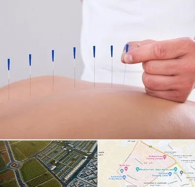 دکتر طب سوزنی در الهیه مشهد