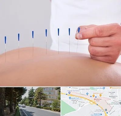 دکتر طب سوزنی در مهرویلا کرج