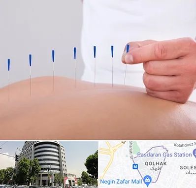 دکتر طب سوزنی در قلهک