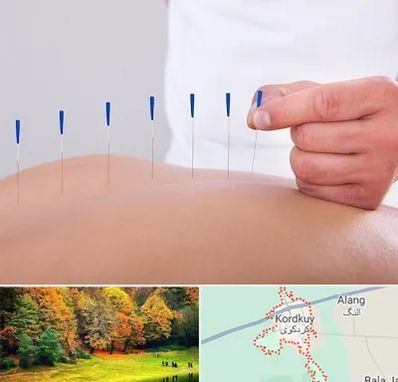 دکتر طب سوزنی در کردکوی