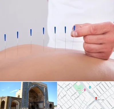 دکتر طب سوزنی در مصلی مشهد