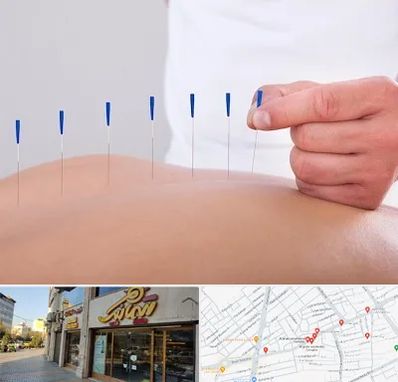 دکتر طب سوزنی در عطاران قم