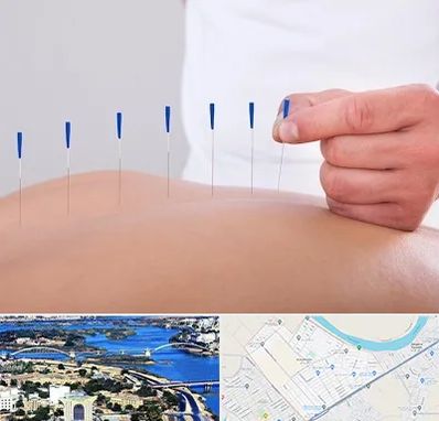 دکتر طب سوزنی در کوروش اهواز