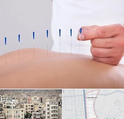 دکتر طب سوزنی در اسکندری