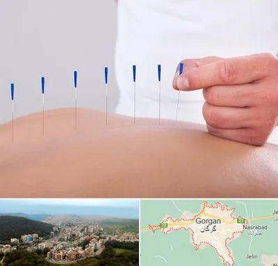 دکتر طب سوزنی در گرگان