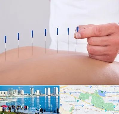 دکتر طب سوزنی در چیتگر 