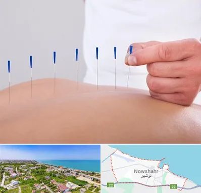 دکتر طب سوزنی در نوشهر