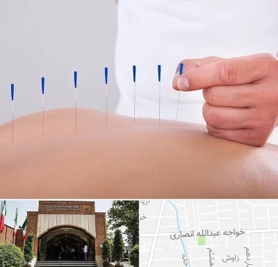 دکتر طب سوزنی در خواجه عبدالله
