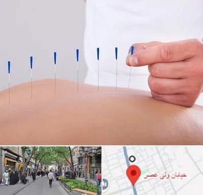 دکتر طب سوزنی در ولیعصر شهریار