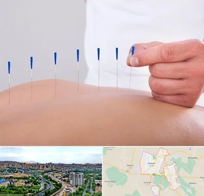 دکتر طب سوزنی در شهریار