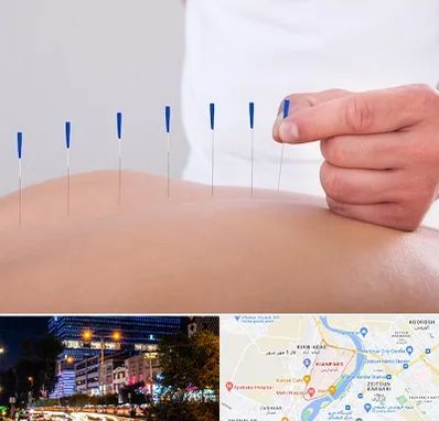 دکتر طب سوزنی در کیانپارس اهواز