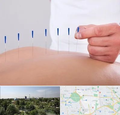 دکتر طب سوزنی در منطقه 16 تهران