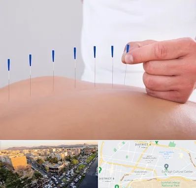 دکتر طب سوزنی در تهرانپارس 