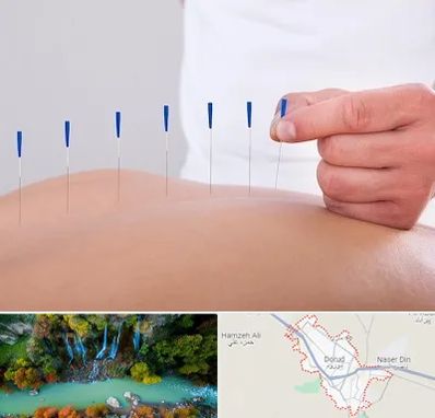 دکتر طب سوزنی در دورود