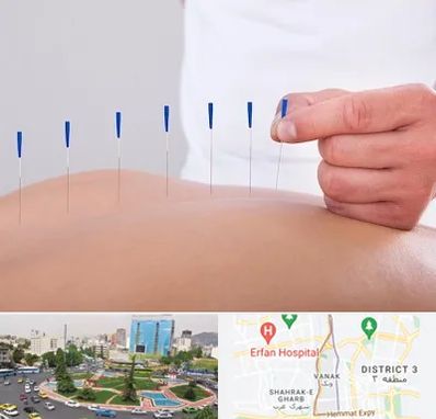 دکتر طب سوزنی در ونک 