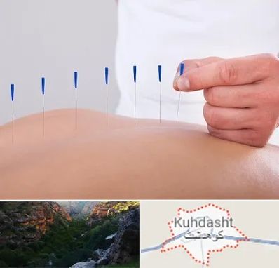 دکتر طب سوزنی در کوهدشت