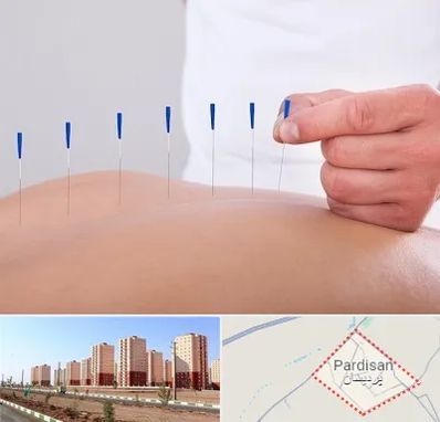 دکتر طب سوزنی در پردیسان قم