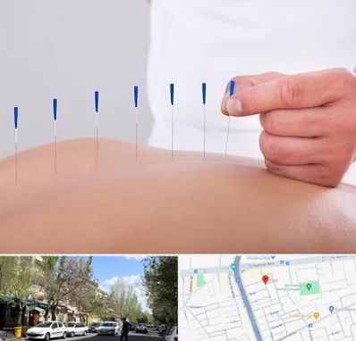 دکتر طب سوزنی در کوی فیروز تبریز