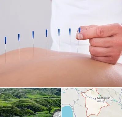 دکتر طب سوزنی در گچساران