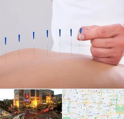 دکتر طب سوزنی در جنت آباد تهران 