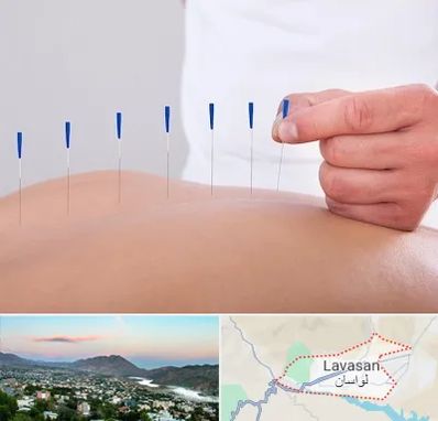 دکتر طب سوزنی در لواسان