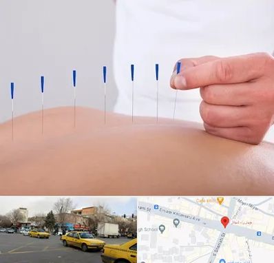 دکتر طب سوزنی در شهناز تبریز