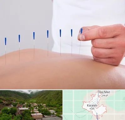 دکتر طب سوزنی در کلاله