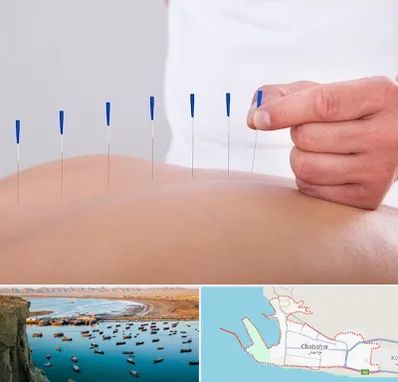 دکتر طب سوزنی در چابهار