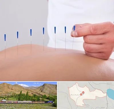 دکتر طب سوزنی در خاش