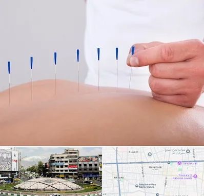 دکتر طب سوزنی در مرکز تهران