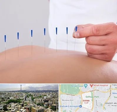 دکتر طب سوزنی در گیشا 