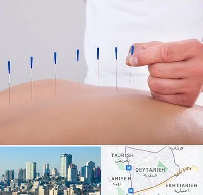 دکتر طب سوزنی در قیطریه 