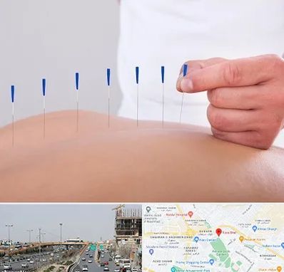 دکتر طب سوزنی در بلوار توس مشهد