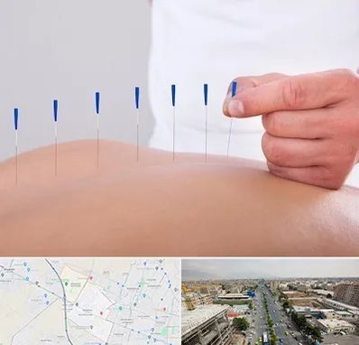 دکتر طب سوزنی در حصارک کرج