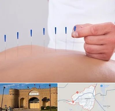 دکتر طب سوزنی در ایرانشهر