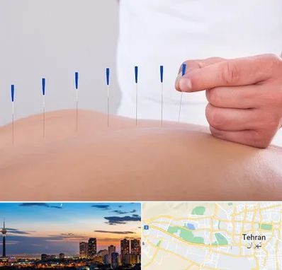 دکتر طب سوزنی در غرب تهران 