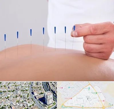 دکتر طب سوزنی در قاسم آباد مشهد