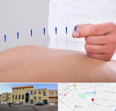 دکتر طب سوزنی در زنبیل آباد قم