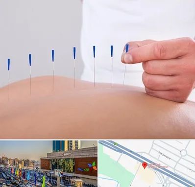 دکتر طب سوزنی در لاله پارک تبریز