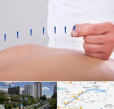 دکتر طب سوزنی در اندرزگو