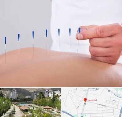 دکتر طب سوزنی در بلوار تعاون
