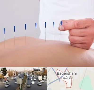 دکتر طب سوزنی در باقرشهر