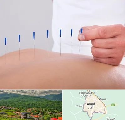 دکتر طب سوزنی در آمل