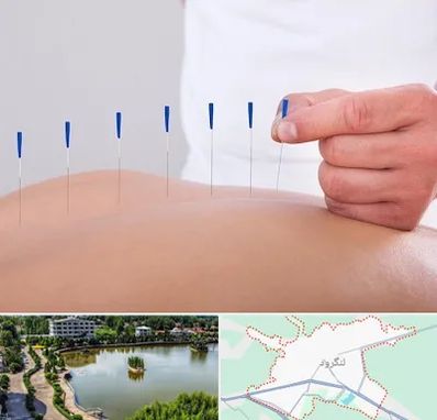 دکتر طب سوزنی در لنگرود