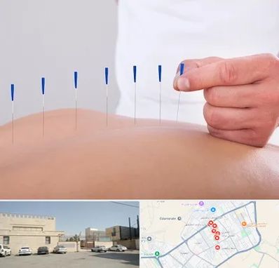 دکتر طب سوزنی در نواب اسلامشهر